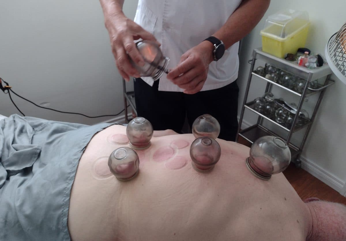 Glass cups placed along a client’s back during a fire cupping treatment.